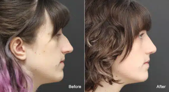 Rhinoplasty Before and After Photos in Princeton, NJ, Patient 9177