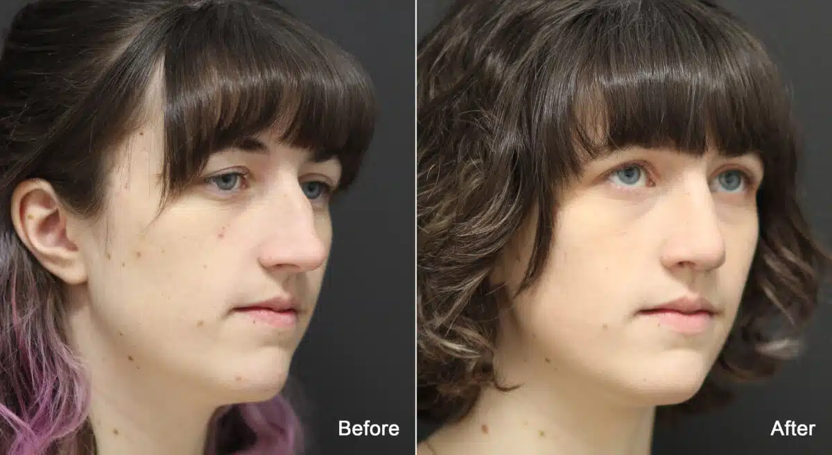 Rhinoplasty Before and After Photos in Princeton, NJ, Patient 9177