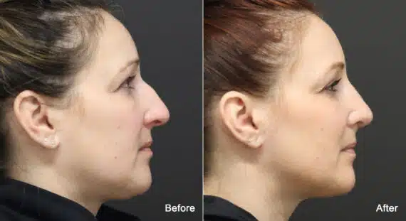 Rhinoplasty Before and After Photos in Princeton, NJ, Patient 9187