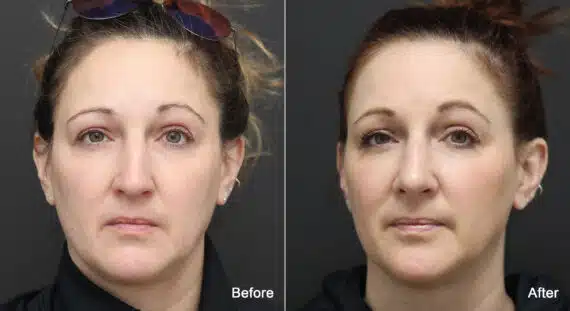 Rhinoplasty Before and After Photos in Princeton, NJ, Patient 9187