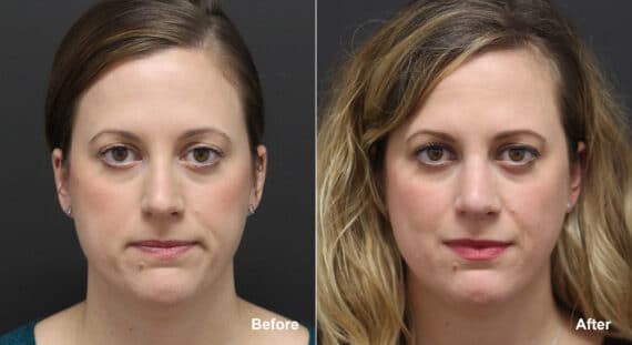 Rhinoplasty Before and After Photos in Princeton, NJ, Patient 9367