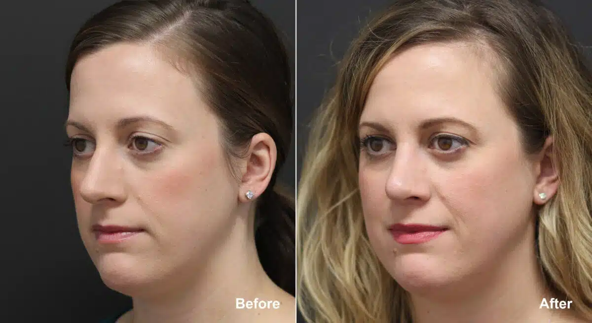 Rhinoplasty Before and After Photos in Princeton, NJ, Patient 9367