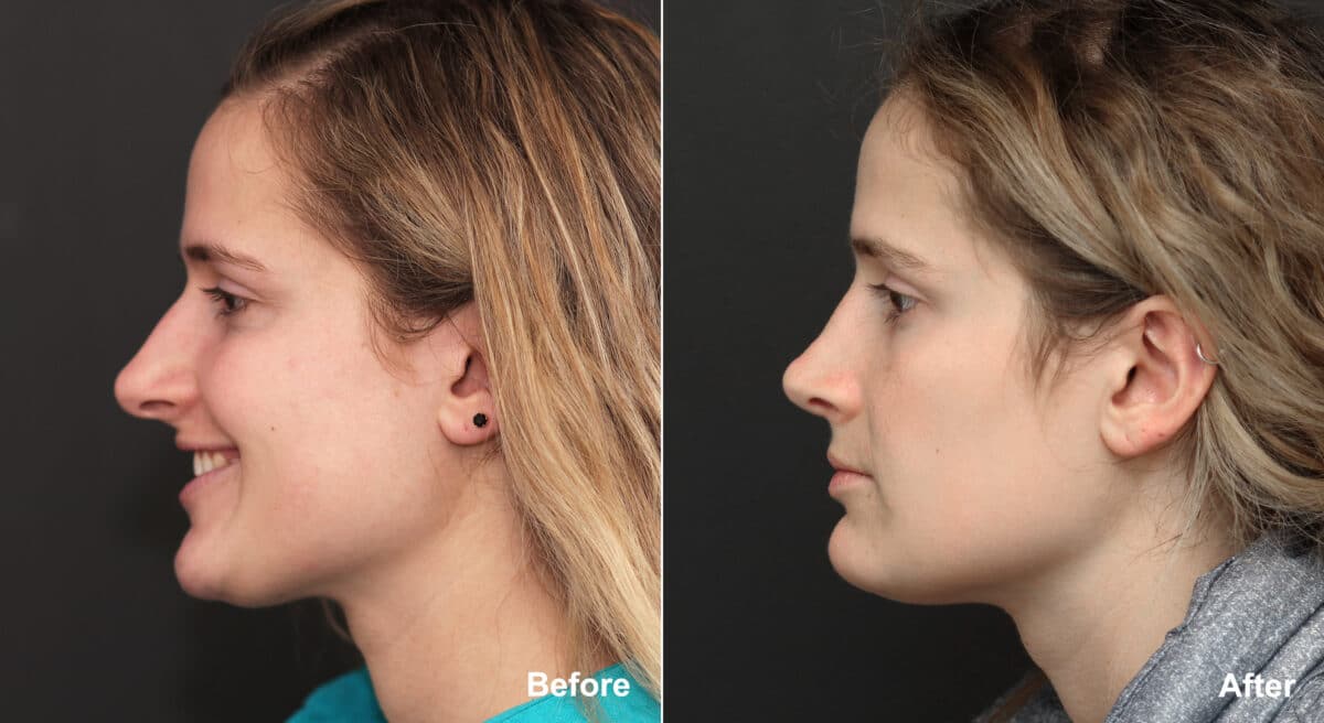 Rhinoplasty Before and After Photos in Princeton, NJ, Patient 8867