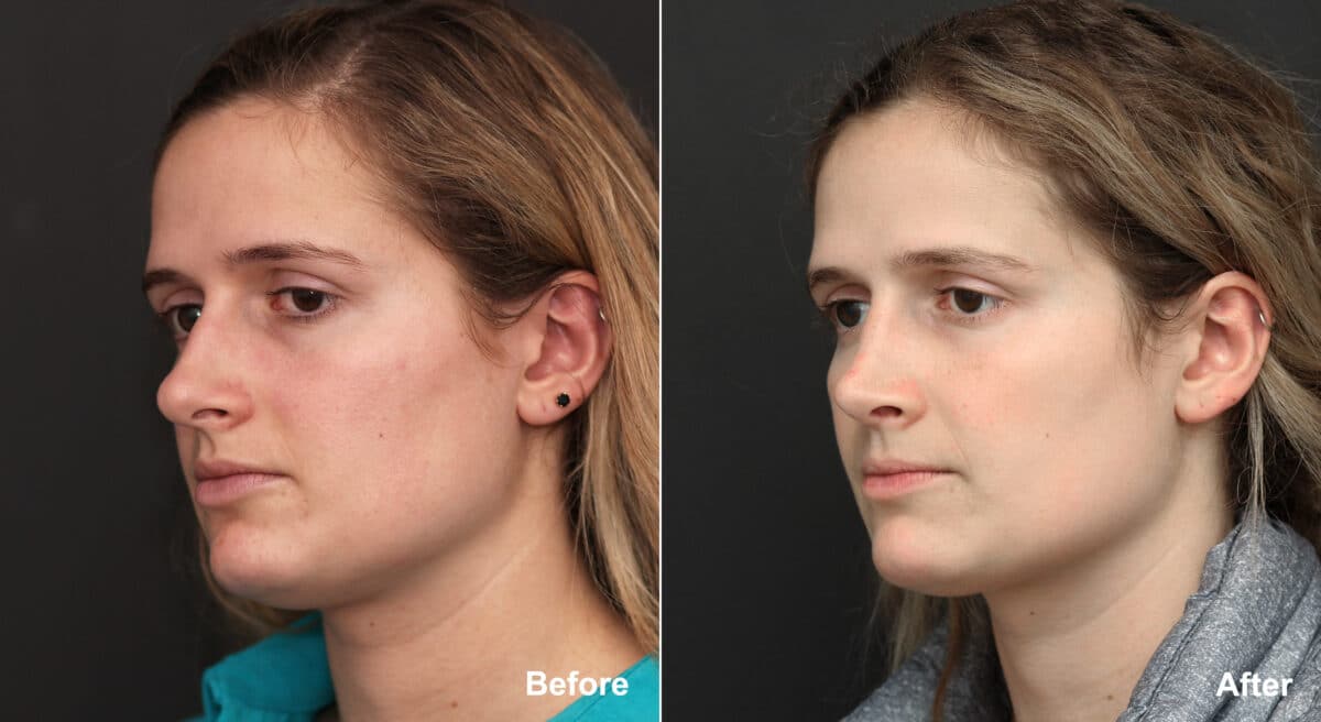 Rhinoplasty Before and After Photos in Princeton, NJ, Patient 8867