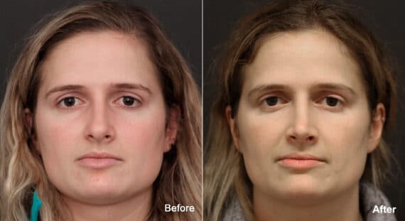 Rhinoplasty Before and After Photos in Princeton, NJ, Patient 8867