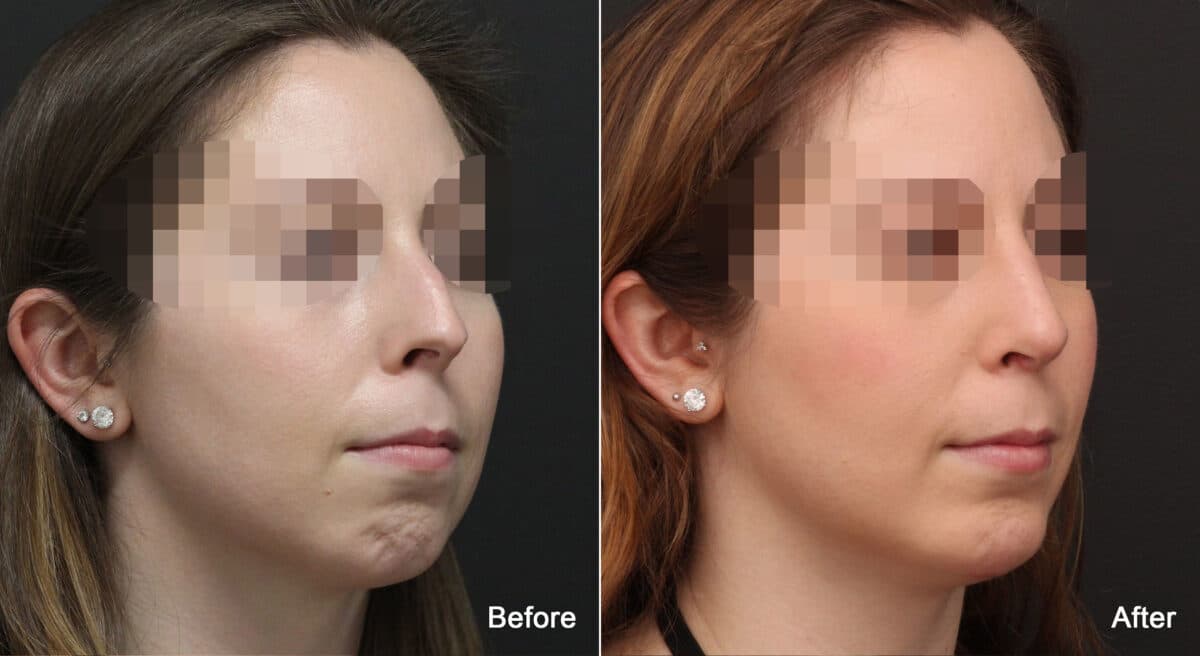 Rhinoplasty Before and After Photos in Princeton, NJ, Patient 8941