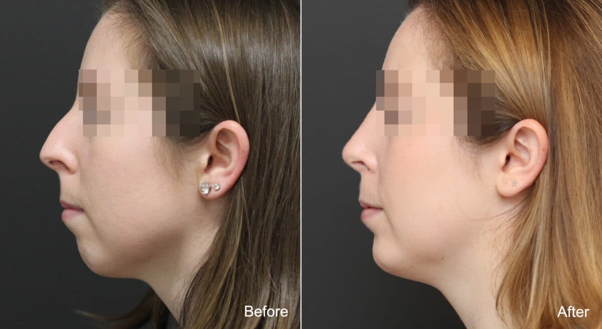 Rhinoplasty Before and After Photos in Princeton, NJ, Patient 8941