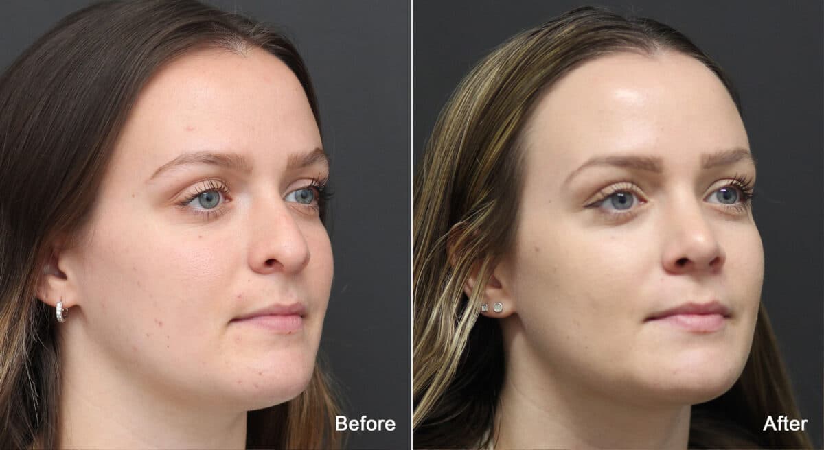 Rhinoplasty Before and After Photos in Princeton, NJ, Patient 9132