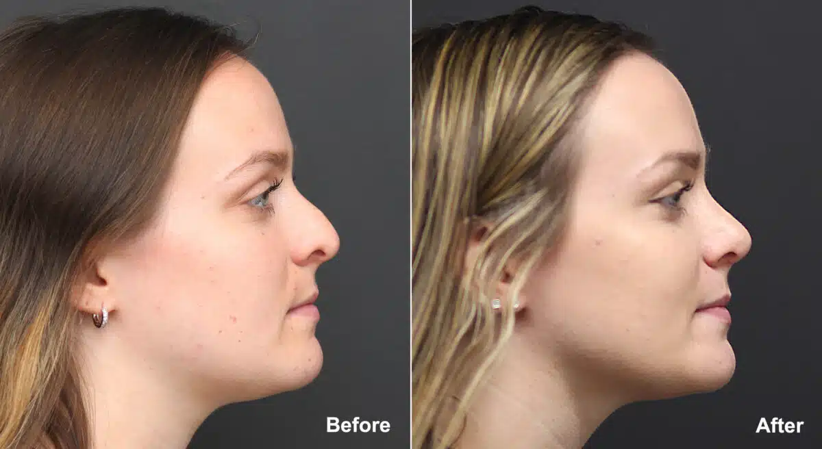 Rhinoplasty Before and After Photos in Princeton, NJ, Patient 9132