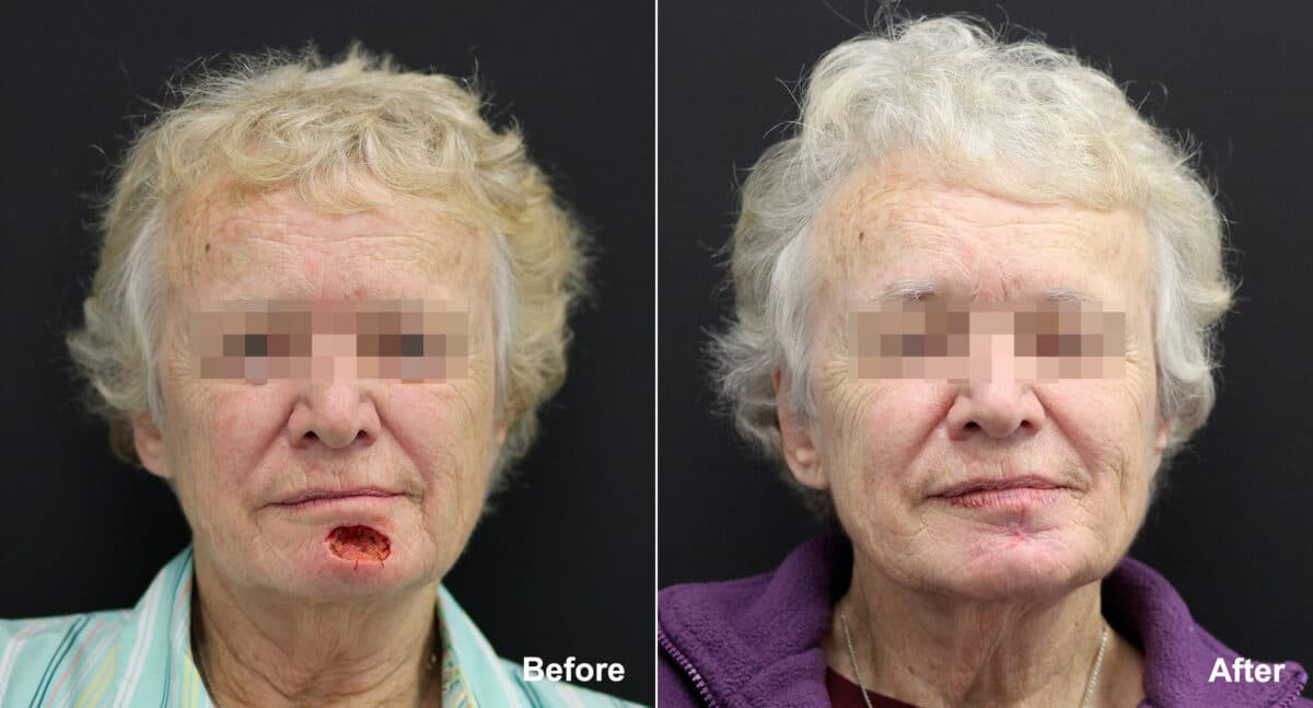 Reconstructive Surgery Before and After Photos in Princeton, NJ, Patient 9830