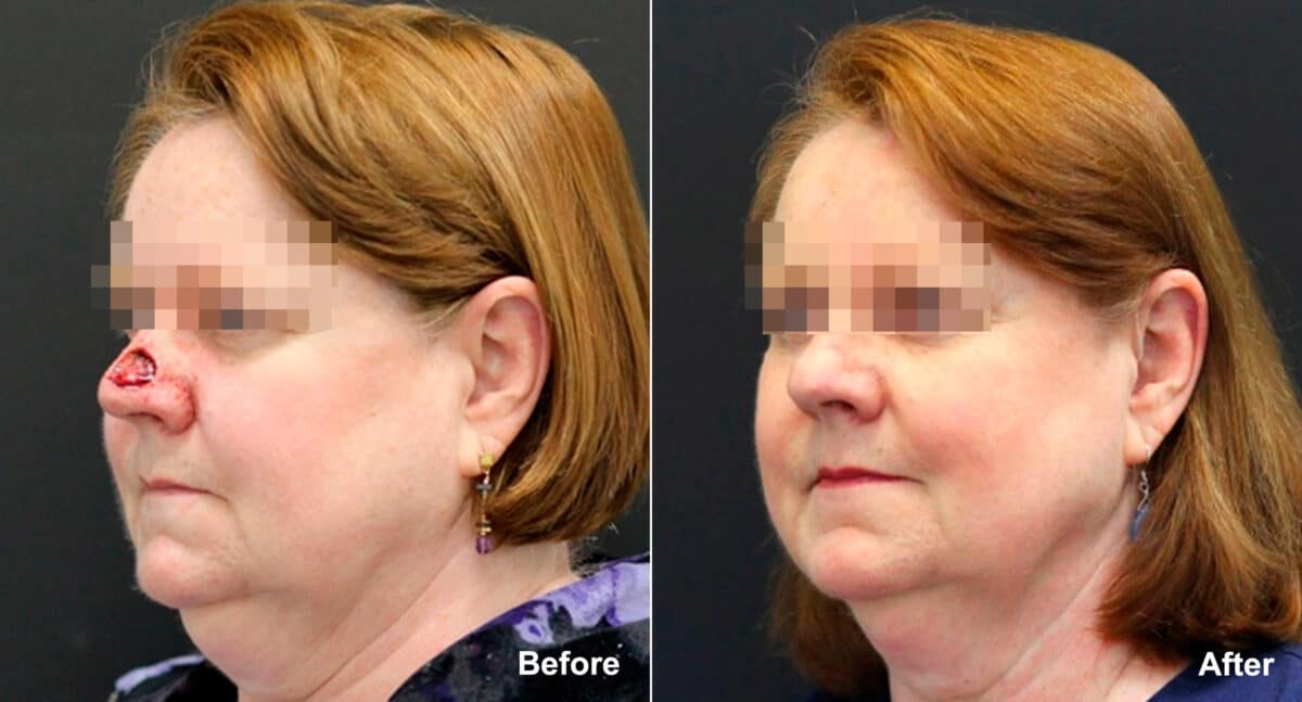 Reconstructive Surgery Before and After Photos in Princeton, NJ, Patient 9832