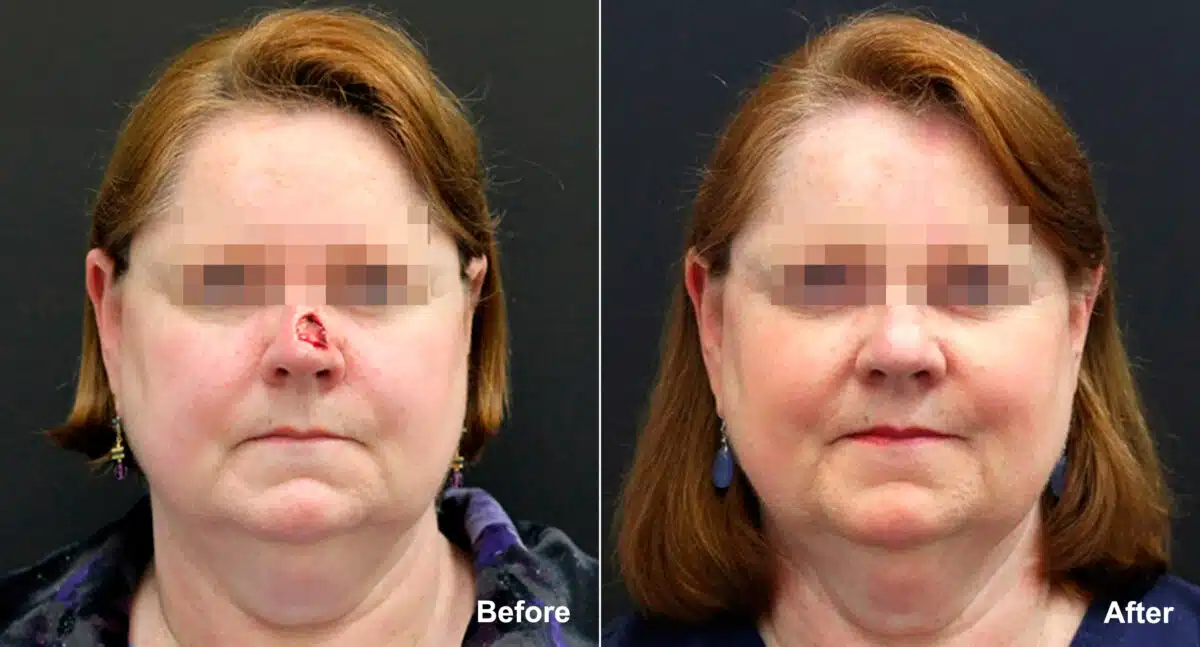 Reconstructive Surgery Before and After Photos in Princeton, NJ, Patient 9832