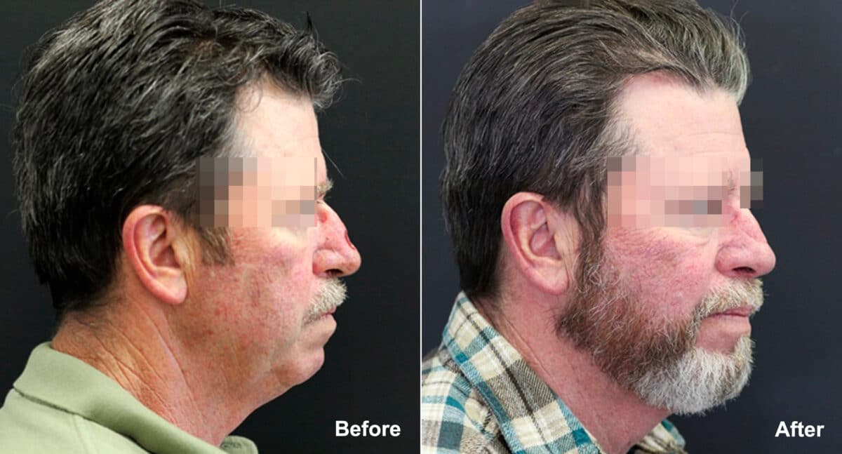 Reconstructive Surgery Before and After Photos in Princeton, NJ, Patient 9833