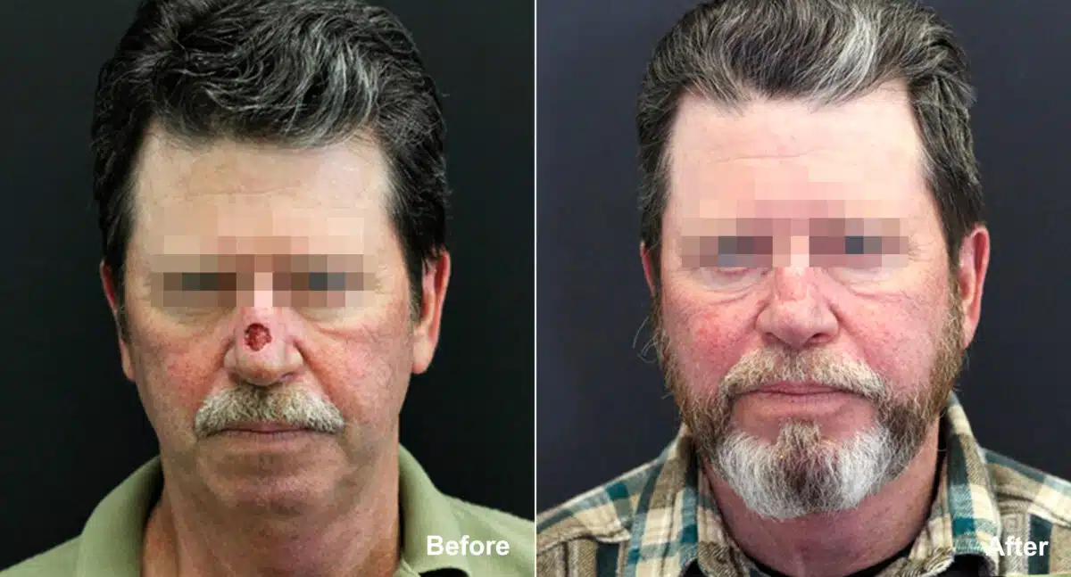 Reconstructive Surgery Before and After Photos in Princeton, NJ, Patient 9833