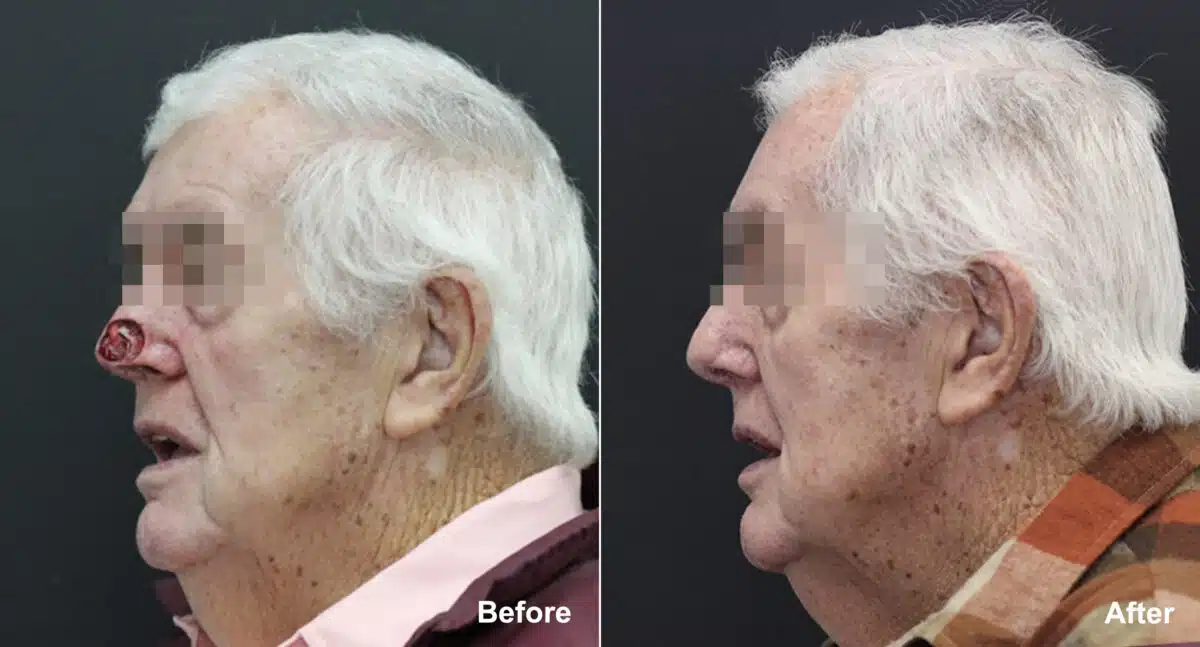 Reconstructive Surgery Before and After Photos in Princeton, NJ, Patient 9874