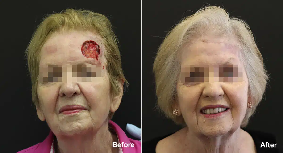 Reconstructive Surgery Before and After Photos in Princeton, NJ, Patient 9834