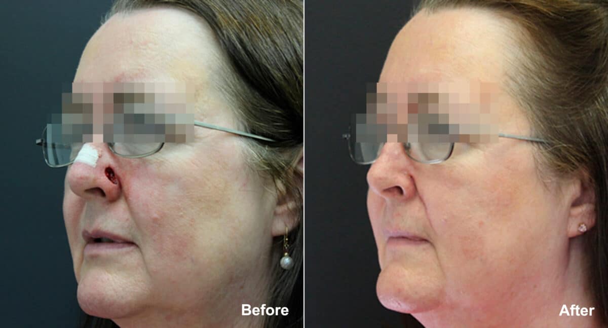 Reconstructive Surgery Before and After Photos in Princeton, NJ, Patient 9865