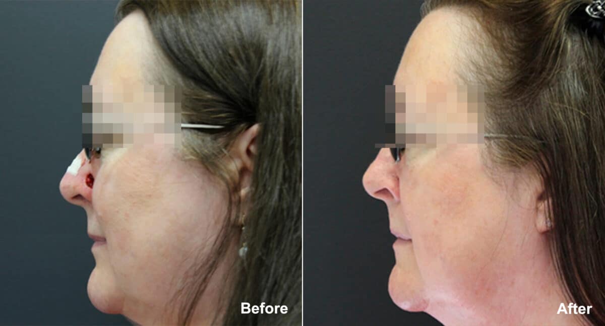 Reconstructive Surgery Before and After Photos in Princeton, NJ, Patient 9865