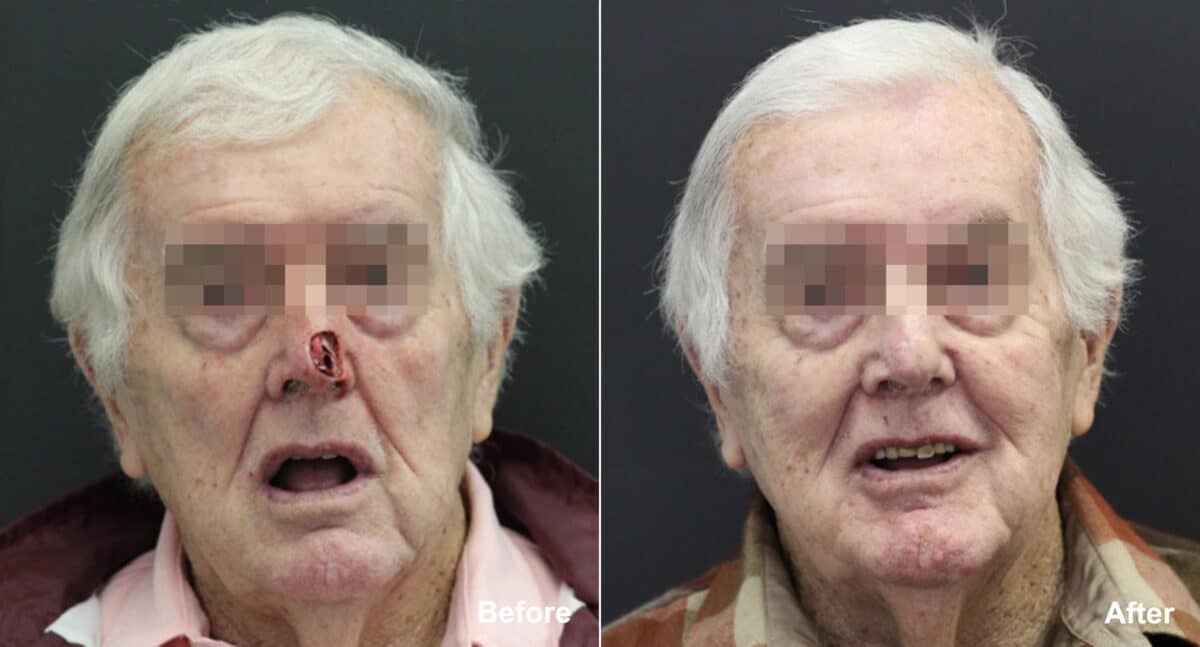 Reconstructive Surgery Before and After Photos in Princeton, NJ, Patient 9874