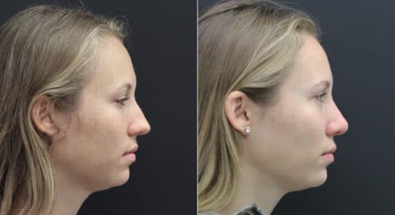 Rhinoplasty Before and After Photos in Princeton, NJ, Patient 9749