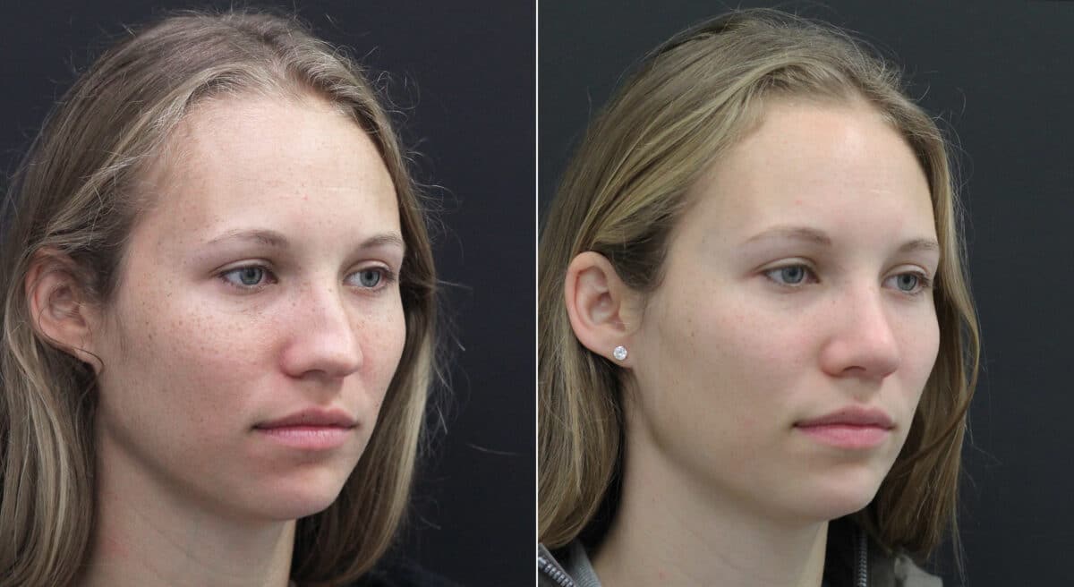Rhinoplasty Before and After Photos in Princeton, NJ, Patient 9749