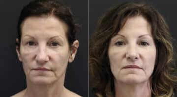 Rhinoplasty Before and After Photos in Princeton, NJ, Patient 9760