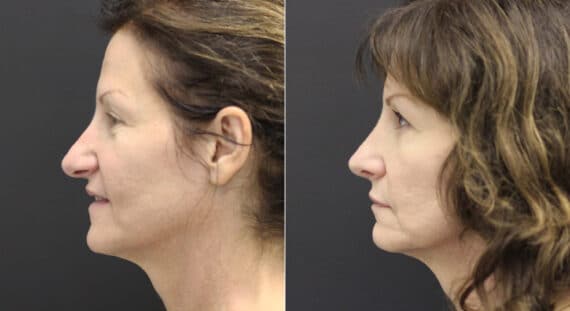 Rhinoplasty Before and After Photos in Princeton, NJ, Patient 9760