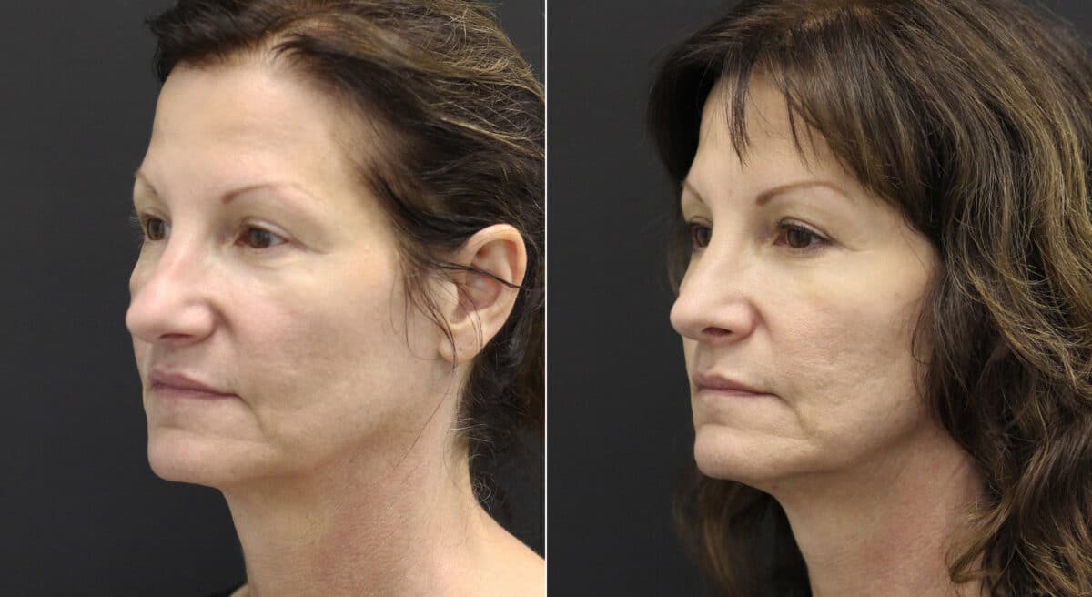 Rhinoplasty Before and After Photos in Princeton, NJ, Patient 9760