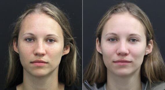 Rhinoplasty Before and After Photos in Princeton, NJ, Patient 9749