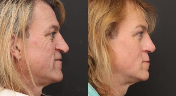 Rhinoplasty Before and After Photos in Princeton, NJ, Patient 9763