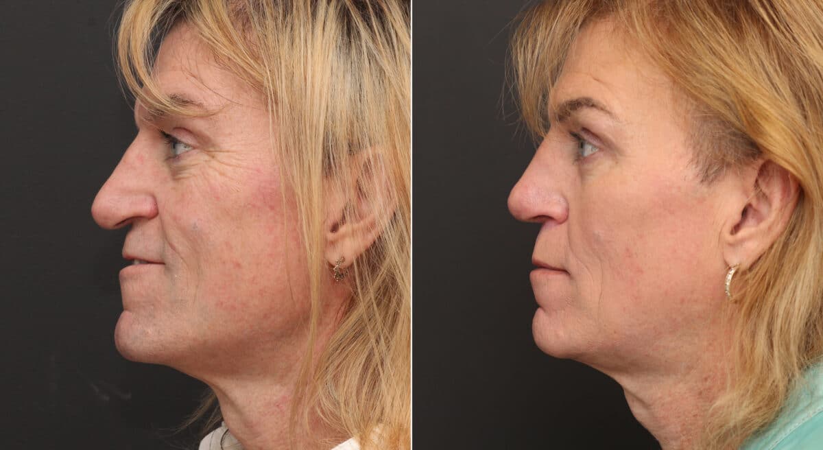 Rhinoplasty Before and After Photos in Princeton, NJ, Patient 9763