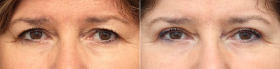 Upper Eyelid Surgery Before and After Photos in Princeton, NJ, Patient 9734