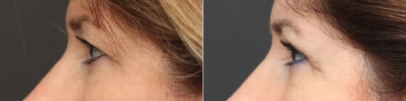 Upper Eyelid Surgery Before and After Photos in Princeton, NJ, Patient 9734