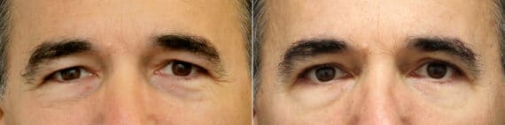 Upper Eyelid Surgery Before and After Photos in Princeton, NJ, Patient 9733