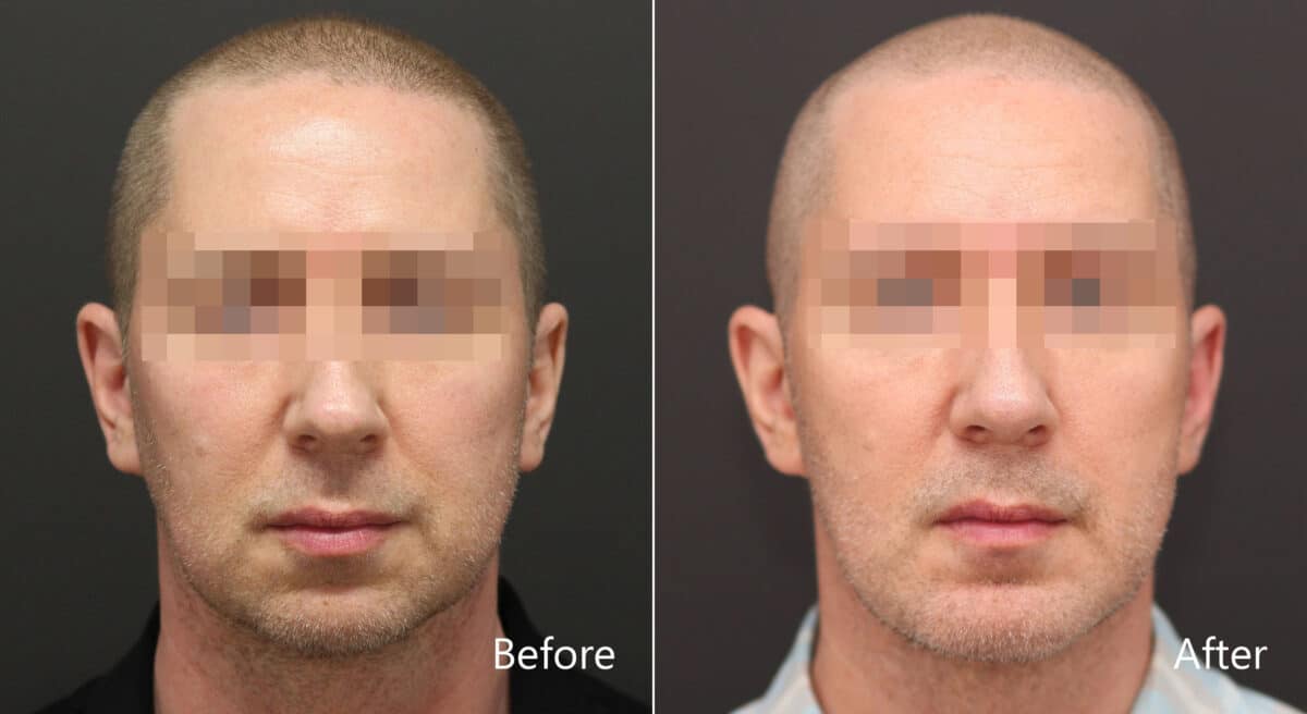 Chin Implants Before and After Photos in Princeton, NJ, Patient 8208