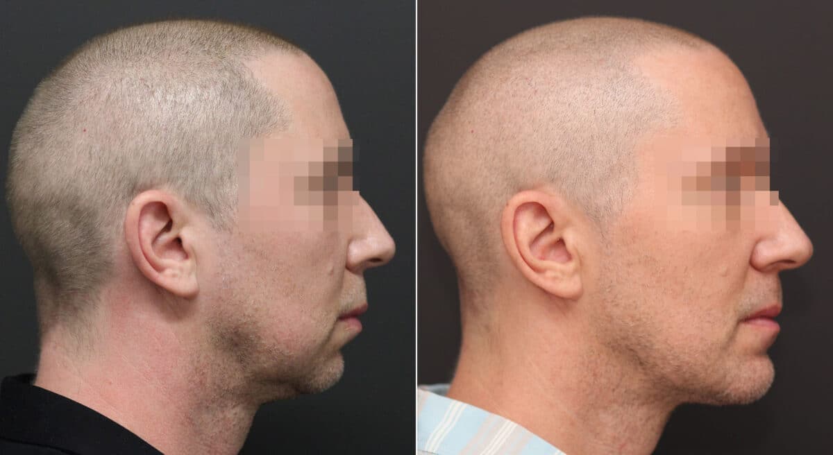 Chin Implants Before and After Photos in Princeton, NJ, Patient 8208