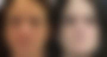 Reconstructive Surgery Before and After Photos in Princeton, NJ, Patient 8729