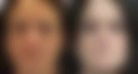 Reconstructive Surgery Before and After Photos in Princeton, NJ