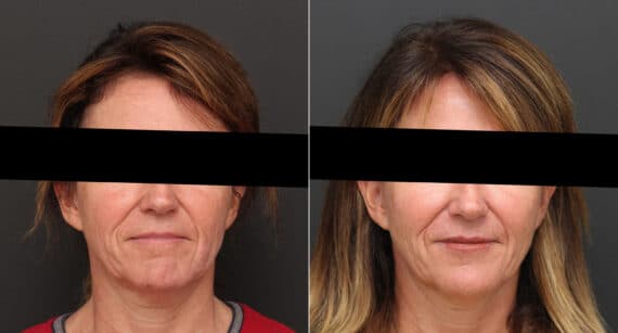 Instalift Before and After Photos in Princeton, NJ, Patient 9382