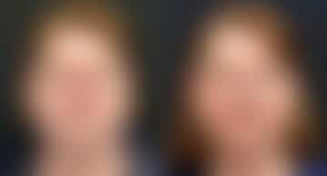 Reconstructive Surgery Before and After Photos in Princeton, NJ, Patient 9832