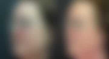 Reconstructive Surgery Before and After Photos in Princeton, NJ, Patient 9865