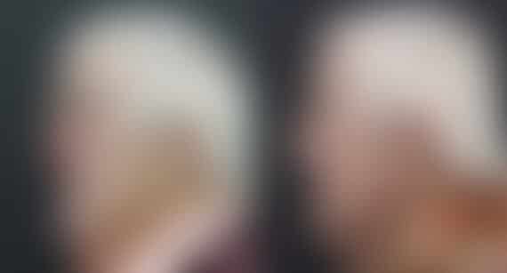 Reconstructive Surgery Before and After Photos in Princeton, NJ, Patient 9874