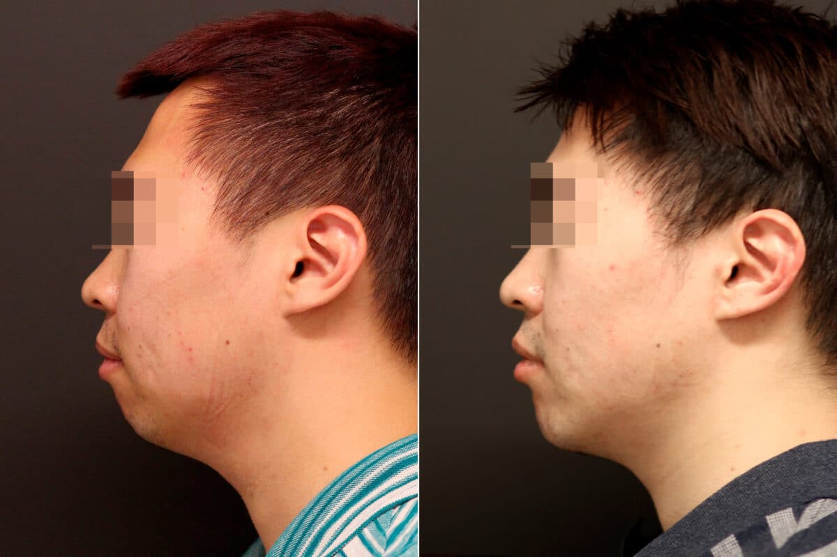 Chin Implants Before and After Photos in Princeton, NJ, Patient 10075