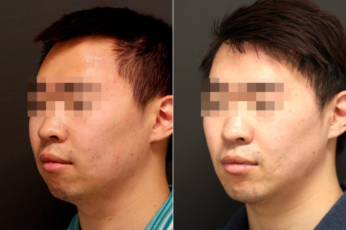 Chin Implants Before and After Photos in Princeton, NJ, Patient 10075