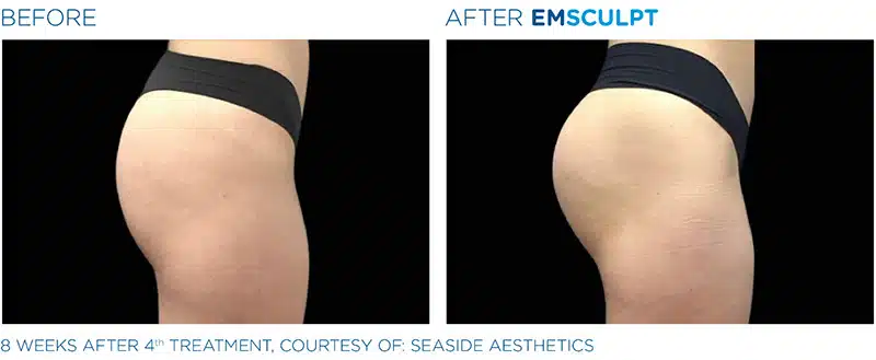 EMSculpt before & after