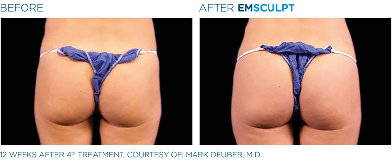 EMSculpt before & after