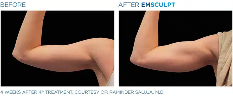 EMSculpt before & after