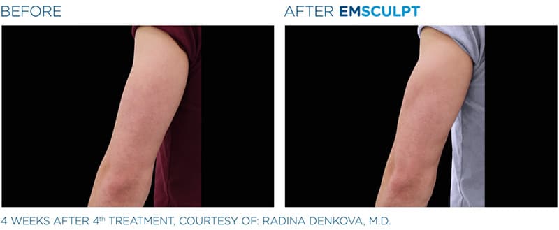 EMSculpt before & after