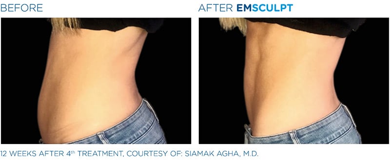 EMSculpt before & after