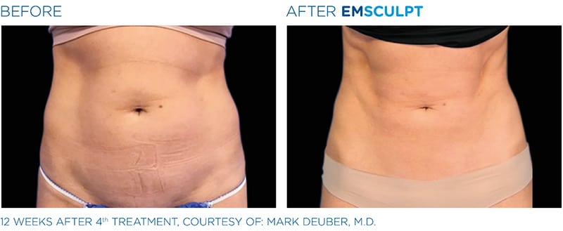 EMSculpt before & after